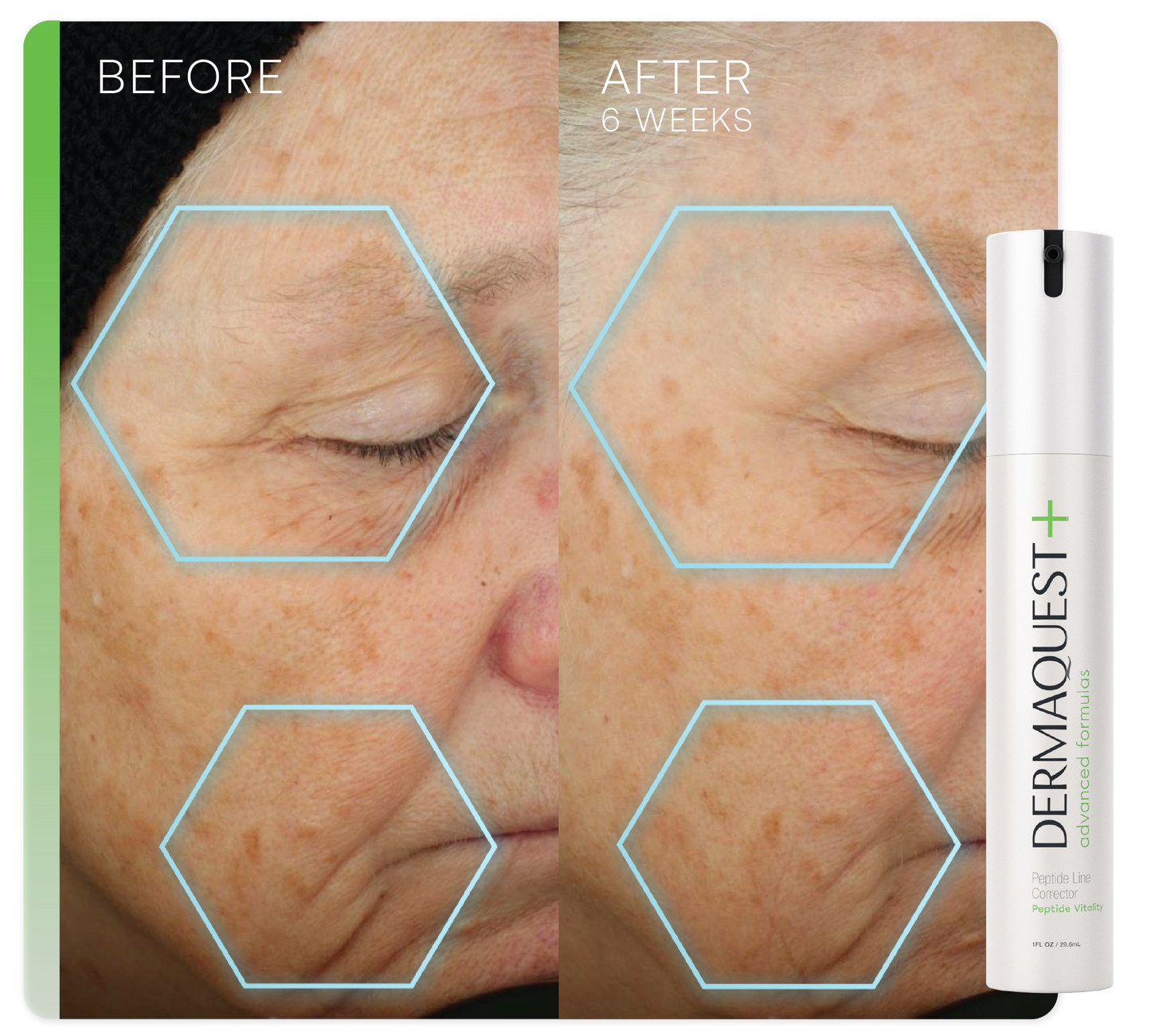 Advanced Peptide Line Corrector