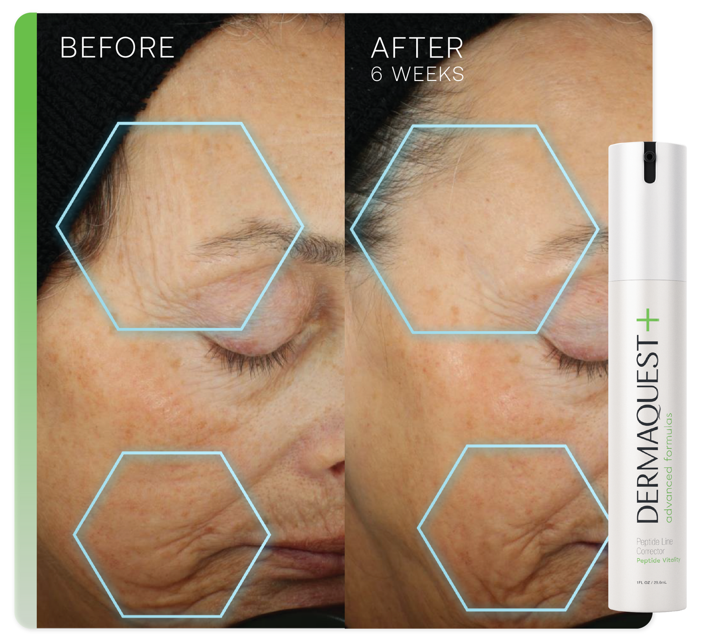 Advanced Peptide Line Corrector