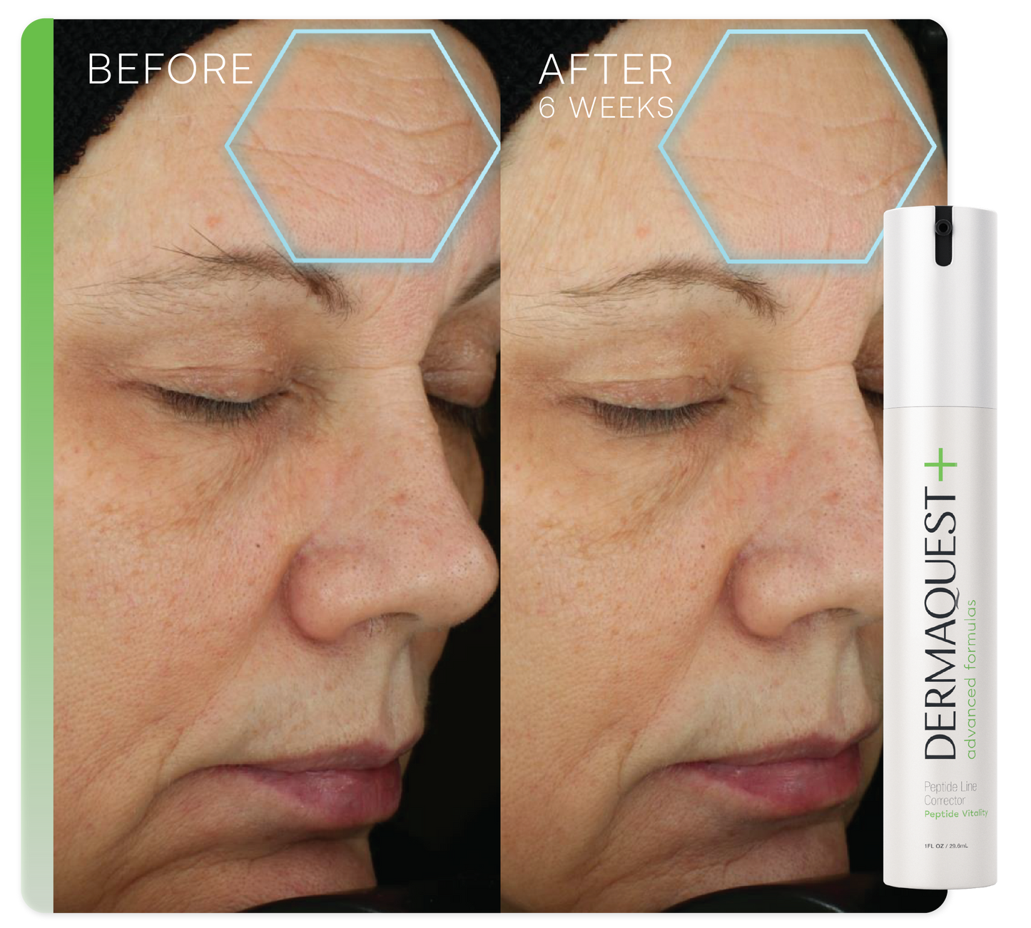 Advanced Peptide Line Corrector