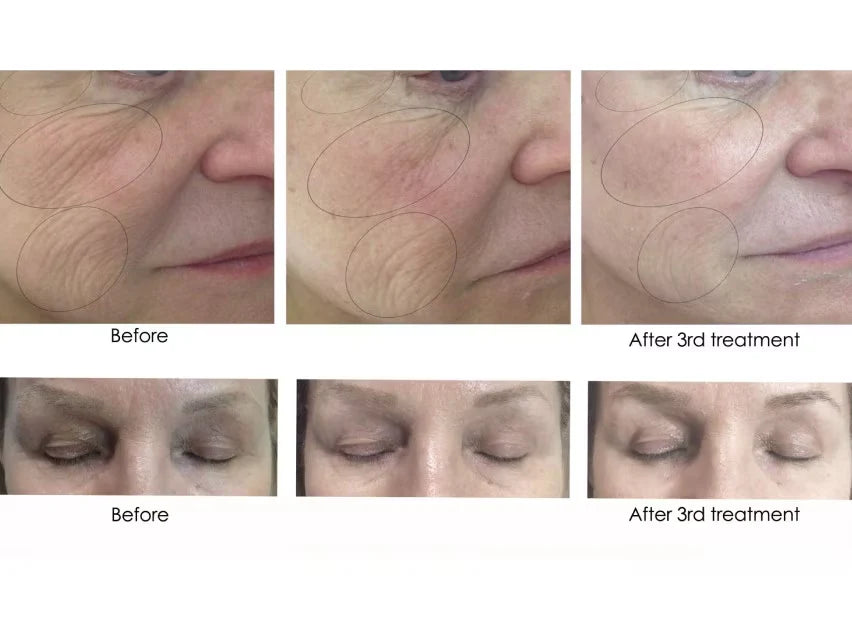CO2lift Carboxy Gel Treatment